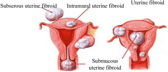 Patients Uterine Fibroids Table - Course Of Fibroids Png