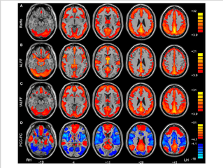 Within - Condition Patterns Of Reho A Alff B Falff C Default Mode Network Png