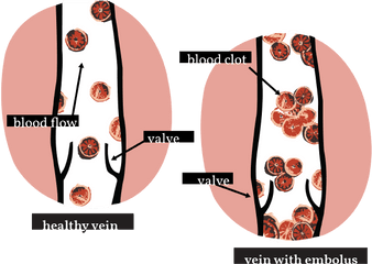 Deep Vein Thrombosis U2014 Womanly Magazine - Circle Png