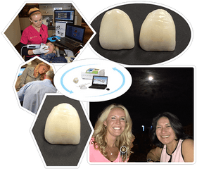 Natural - Looking Sameday Crowns Advance Dentistry Photomontage Png