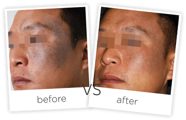 Download Treatment Tattoo Removal And - Poster Png