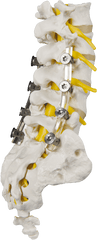 Dynamic Stabilization For Your Back - Spineshape El Implante De Columna Que Se Adapta A La PatologÃ­a Del Paciente Png