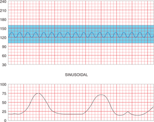 Deceleration In The Fetal Heart Rate - Plot Png