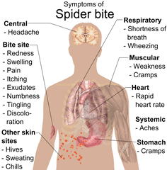 How To Identify Spider Bites Triangle Pest Control - Spider Bite Side Effects Png