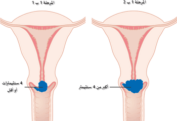 Stage 1b Cervical Cancer Cruk 203 - Stage 1b Cervical Cancer Png