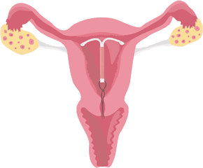 Uterus - Female Reproductive System With Iud Png