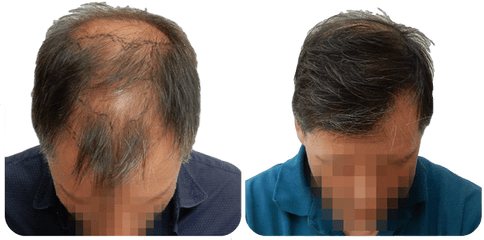 Fue Hair Transplant Procedure Advantages And Cost By - Fue Hair Transplant Results Png