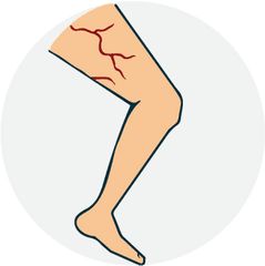 Download Hd Varicose Vein - Illustration Transparent Png Clip Art