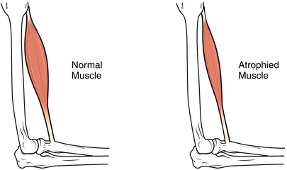 Medical Bed For Muscular Dystrophy - Muscle Atrophy Vs Hypertrophy Png