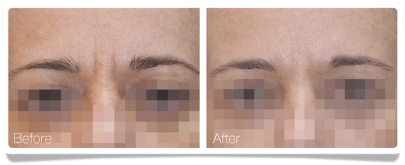 ClÃ­nica Ãureo - Wrinkles Between The Eyebrows Eye Shadow Png