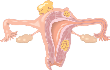 Endometriosis And Fibroids With Connection To Co - Dependancy Baby In The Uterus Png