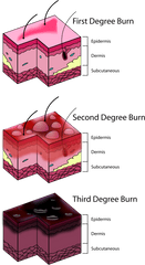 Burn Degree Diagram - Should I Put A Bandaid On A Burn Png